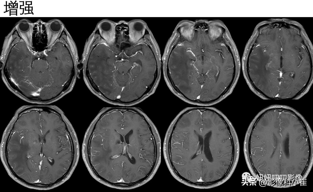 脑部肿瘤疾病有哪些,脑部有病变但是不是肿瘤