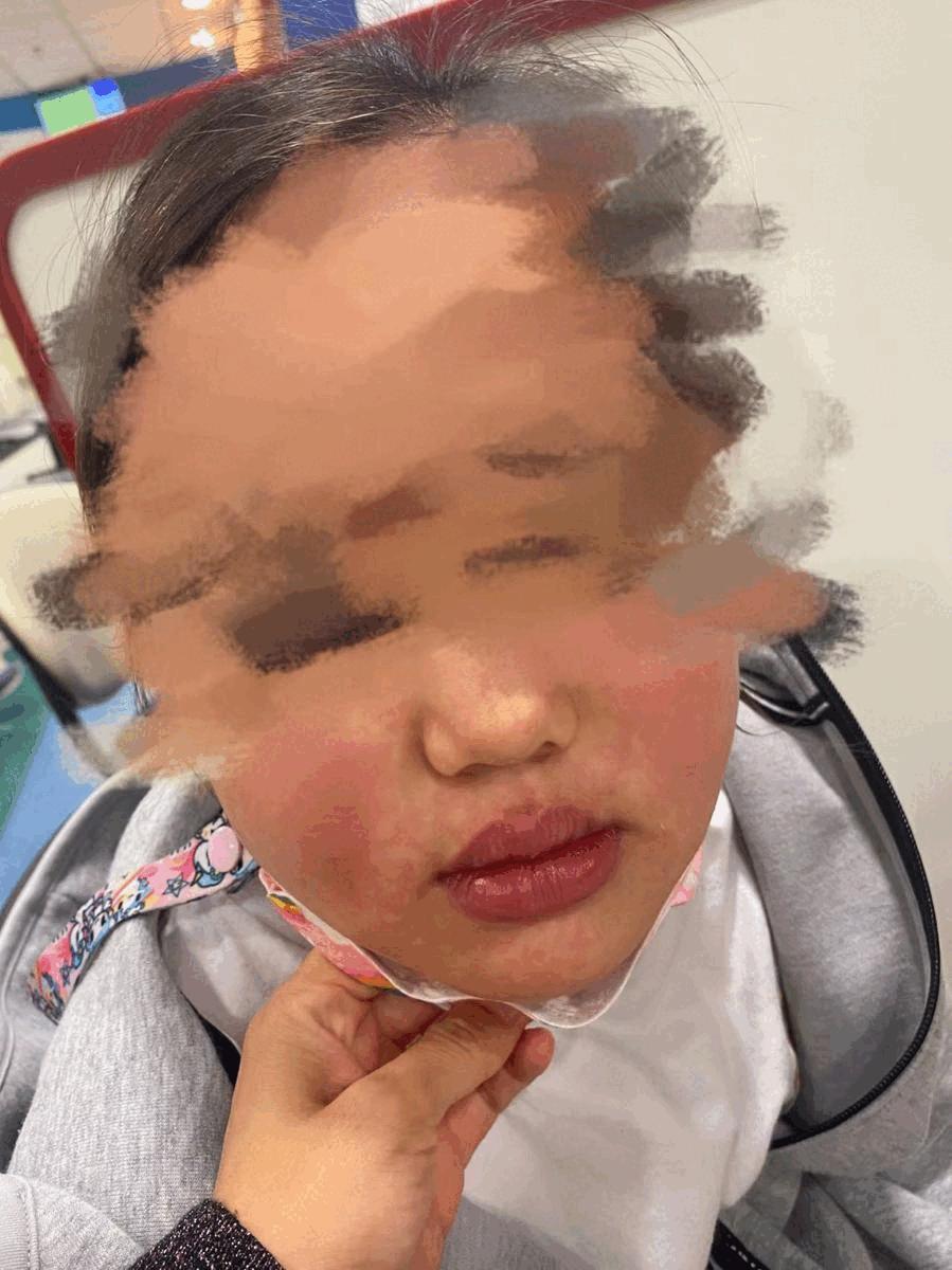 “娃全身红疹，被新加坡医生要求全麻开刀！我该怎么办？”