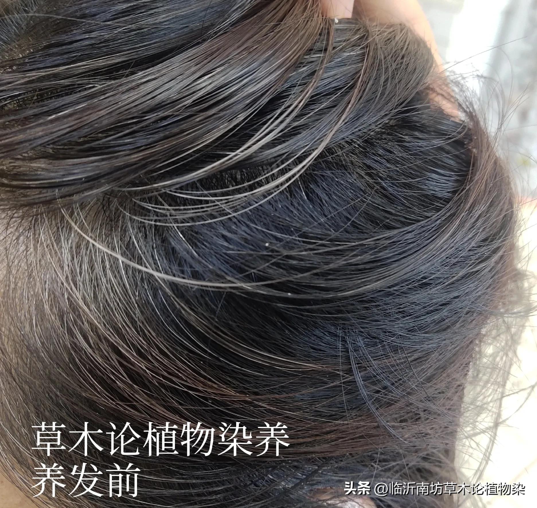 染发过敏头皮痒最快解决方法,染发头皮过敏流水结痂会自愈吗