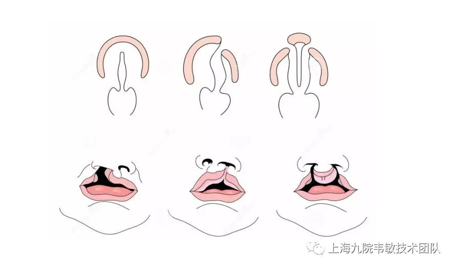 韦敏唇腭裂,上海九院哪个医生做唇腭裂比较好