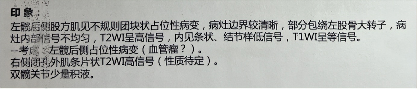 下肢肌间静脉畸形治疗案例,臀部静脉畸形怎么治疗比较好