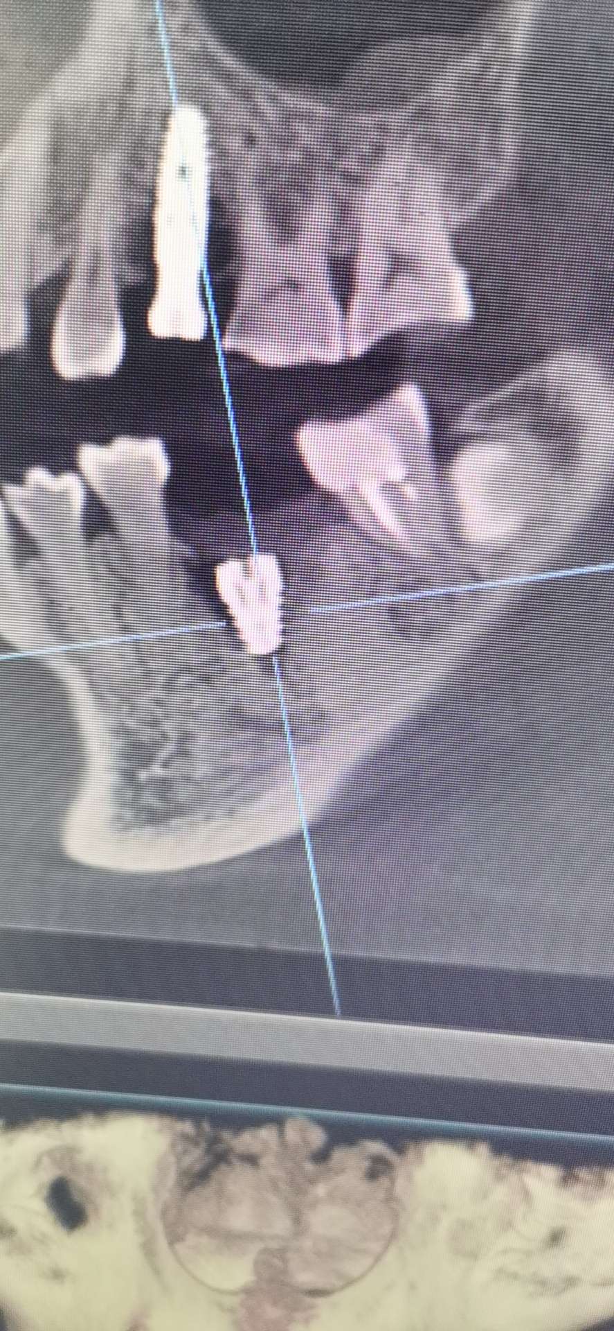 北京大望齿科种一颗牙多少钱,北京私人医院种牙多少钱