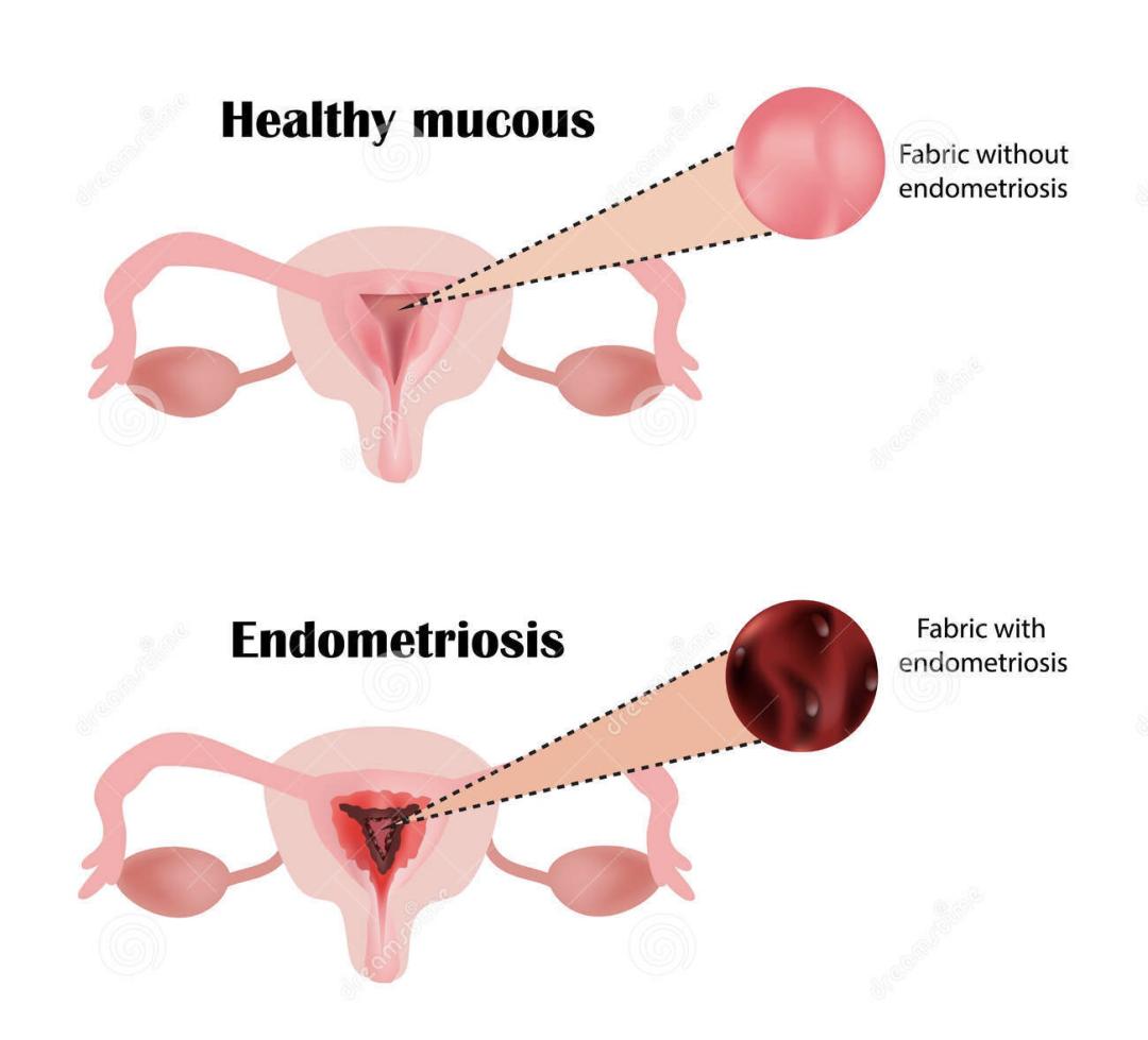子宫内膜与妊娠,子宫内膜避孕器取出手术需要多久