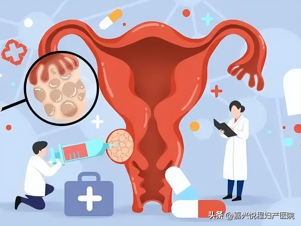 不开刀的子宫肌瘤消融术,子宫肌瘤无创超声消融术费用