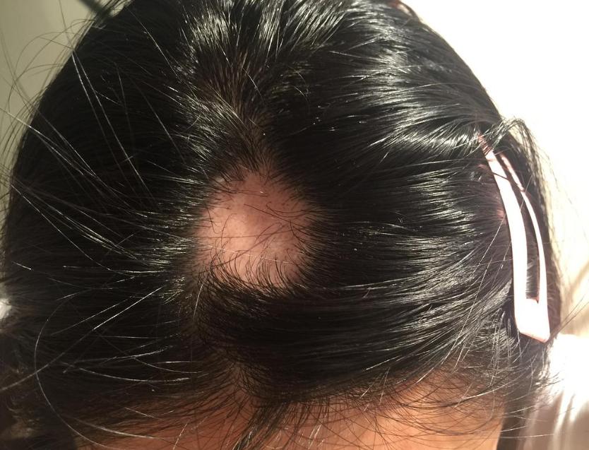 女人以肝为先天什么意思,休止期脱发越来越严重