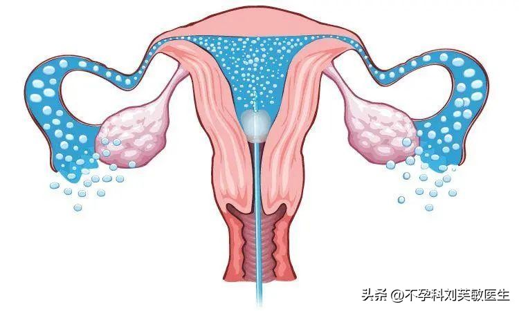 做过人流输卵管堵塞概率多大,没做过人流输卵管会堵吗