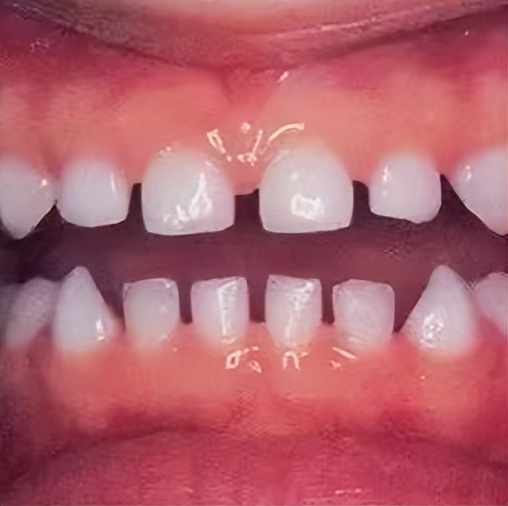 宝宝牙缝大是吃糖引起的吗,宝宝牙缝太宽了吧