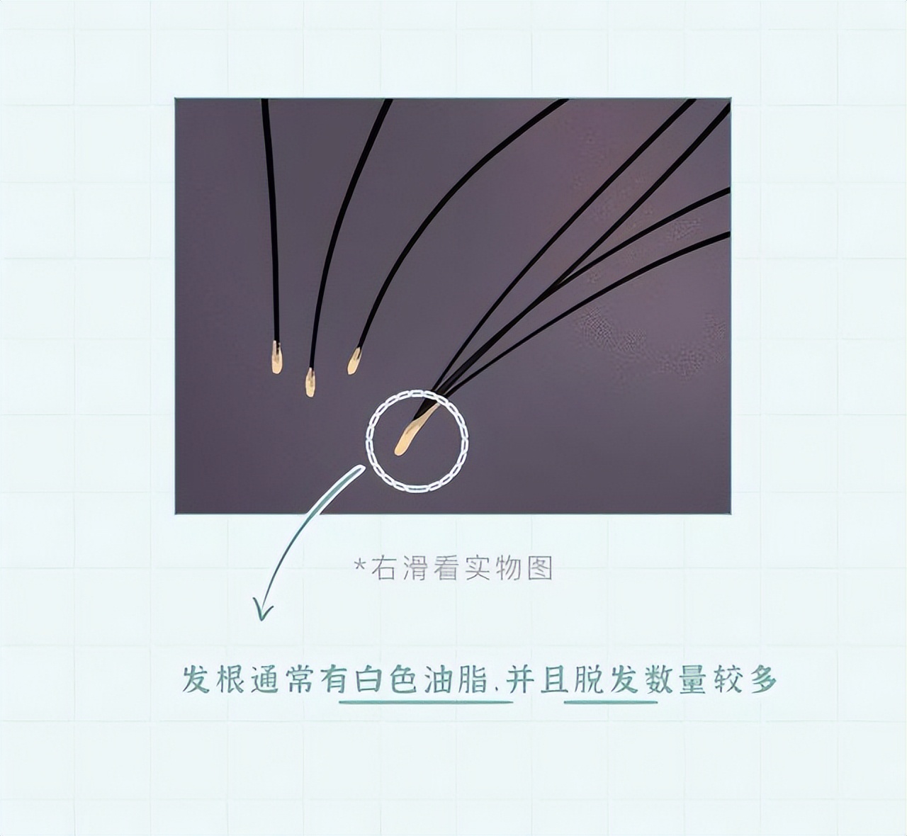 头皮上白色的小颗粒可以抠下来,为什么抓头皮会有白色小颗粒