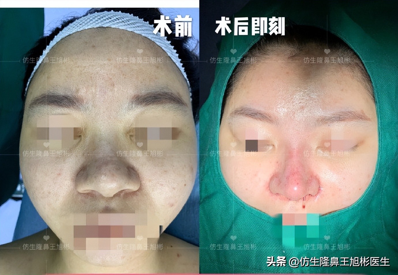 隆鼻鼻头大是失败了吗,大鼻头隆鼻手术案例