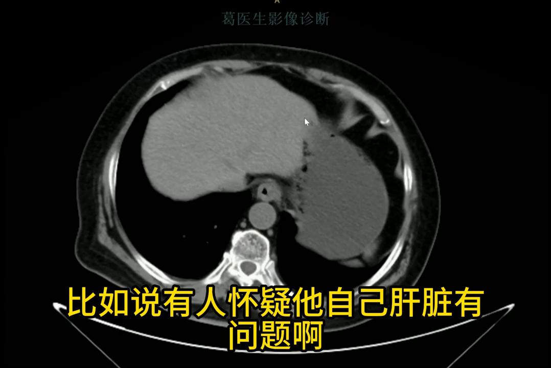 腹部ct影像解剖图谱,腹部ct阑尾影像