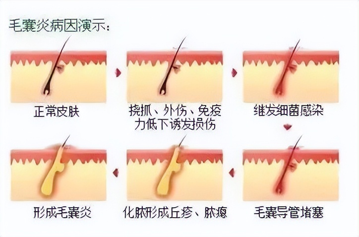 后背长毛囊炎怎么解决,后背长毛囊炎怎么彻底根治