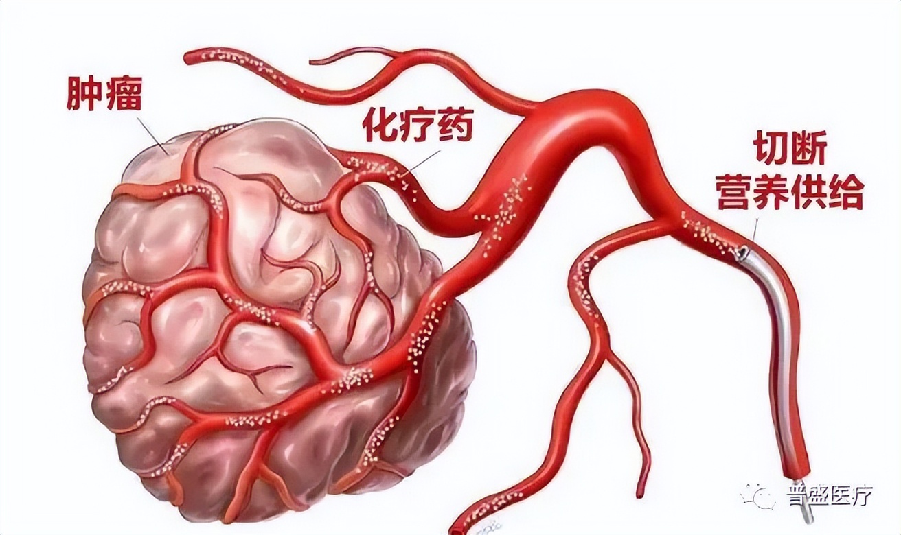 南充治肿瘤最好的医院,南充哪家医院治肿瘤好