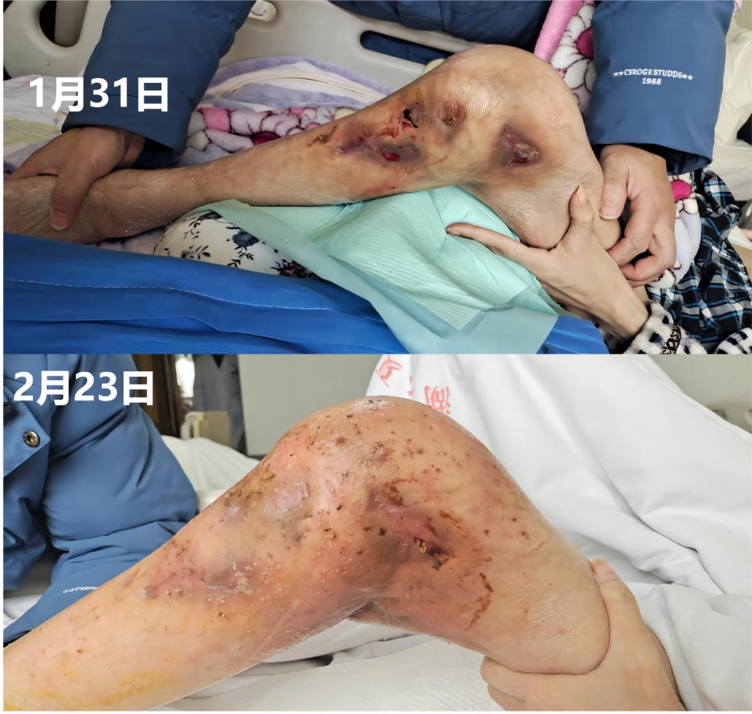 骨结核相关数据,骨结核病