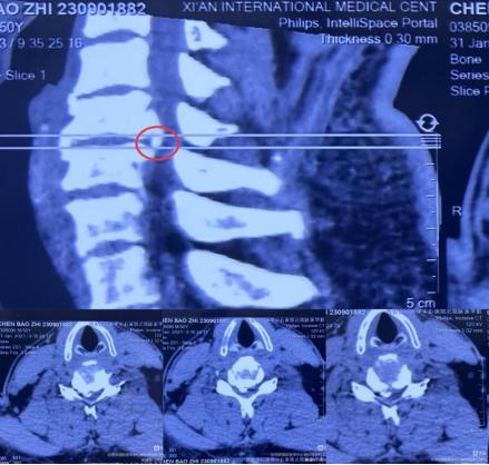 颈椎后路内镜微创手术,颈椎韧带钙化手术切除全过程