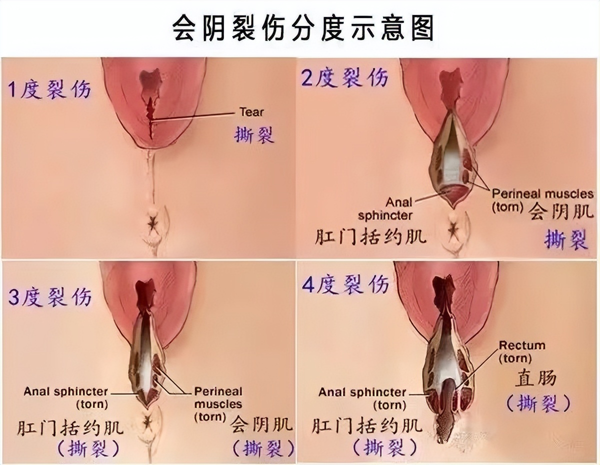 产后20天排出一坨像肠子一样东西,产后第一次大便是墨绿色的