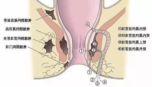 痔疮的中医诊疗方案,痔疮治疗临床经验报道