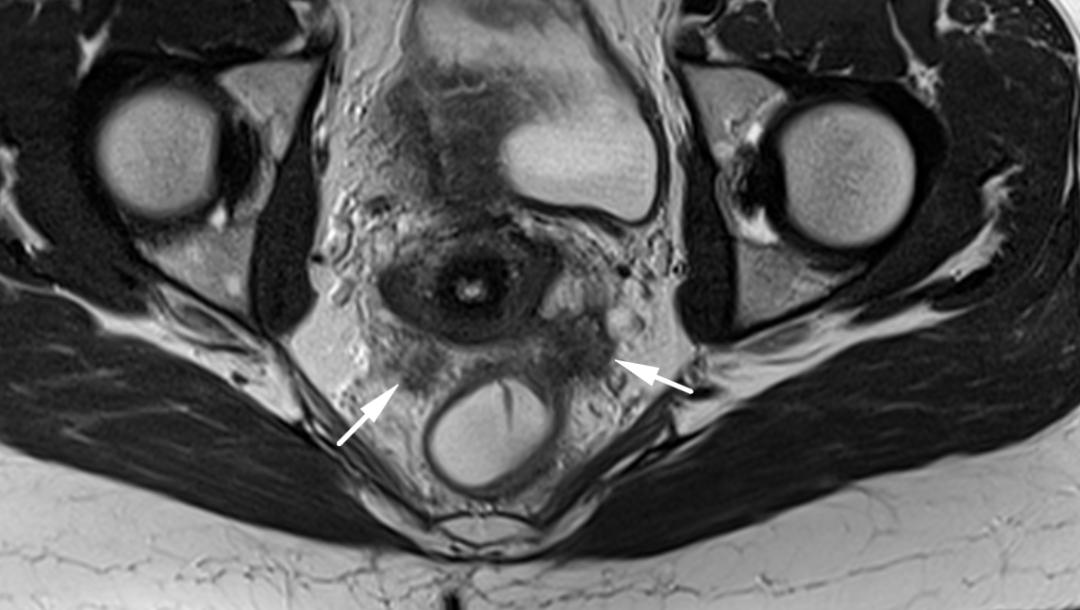 MRI如何评估子宫内膜异位症？这10个病例会帮助您