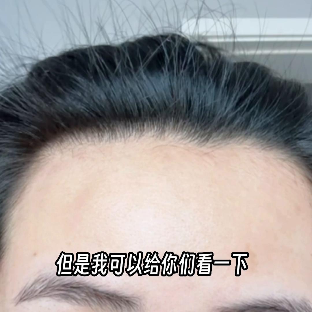 头发这么好，是不是染的、植的？这篇答疑解惑！希望能给大...