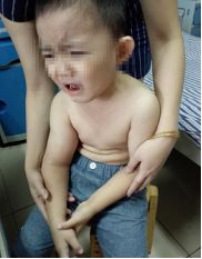 肱骨骨折取钢板怎样恢复,肱骨近端骨折切开复位内固定术