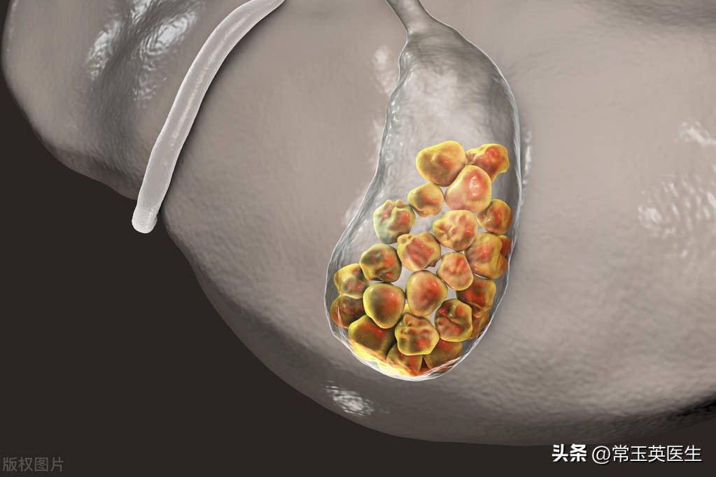 胆囊结石药物溶石效果怎么样,胆囊结石可以药物排石吗