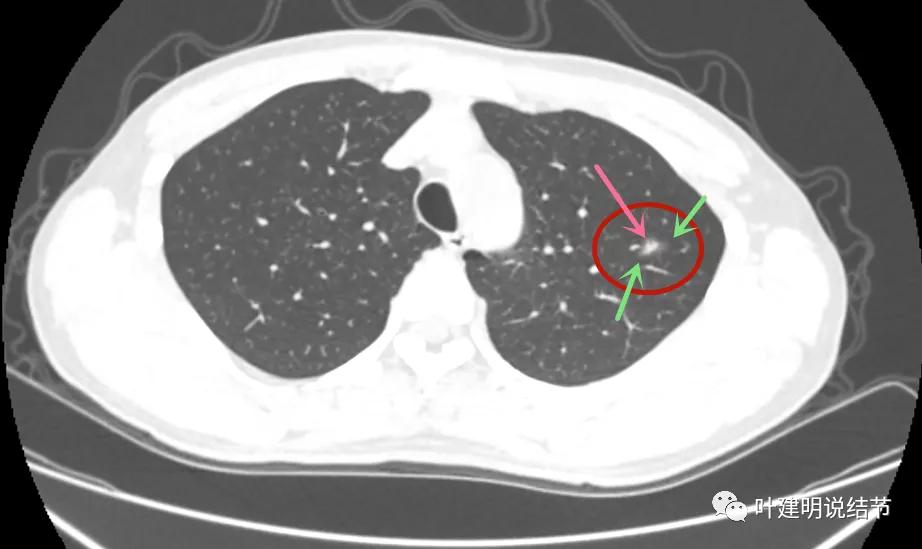 这样的多发病灶给试验性抗结核治疗?消失的结节是药的功劳吗?