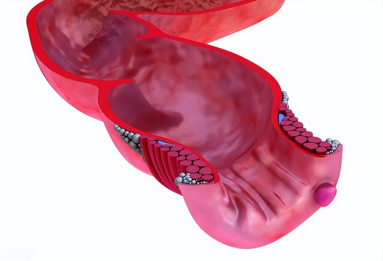 错把直肠癌当痔疮手术的后果,肛门癌与痔疮的症状和前兆