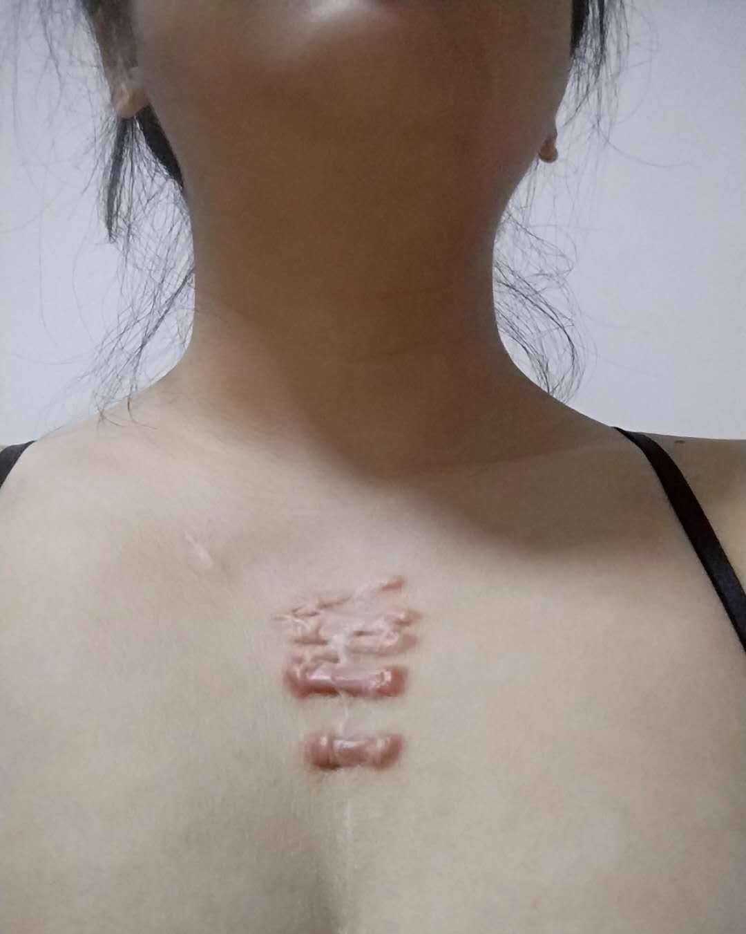 心脏手术疤痕一半增生一半没增生,心脏手术20年疤痕能修复吗