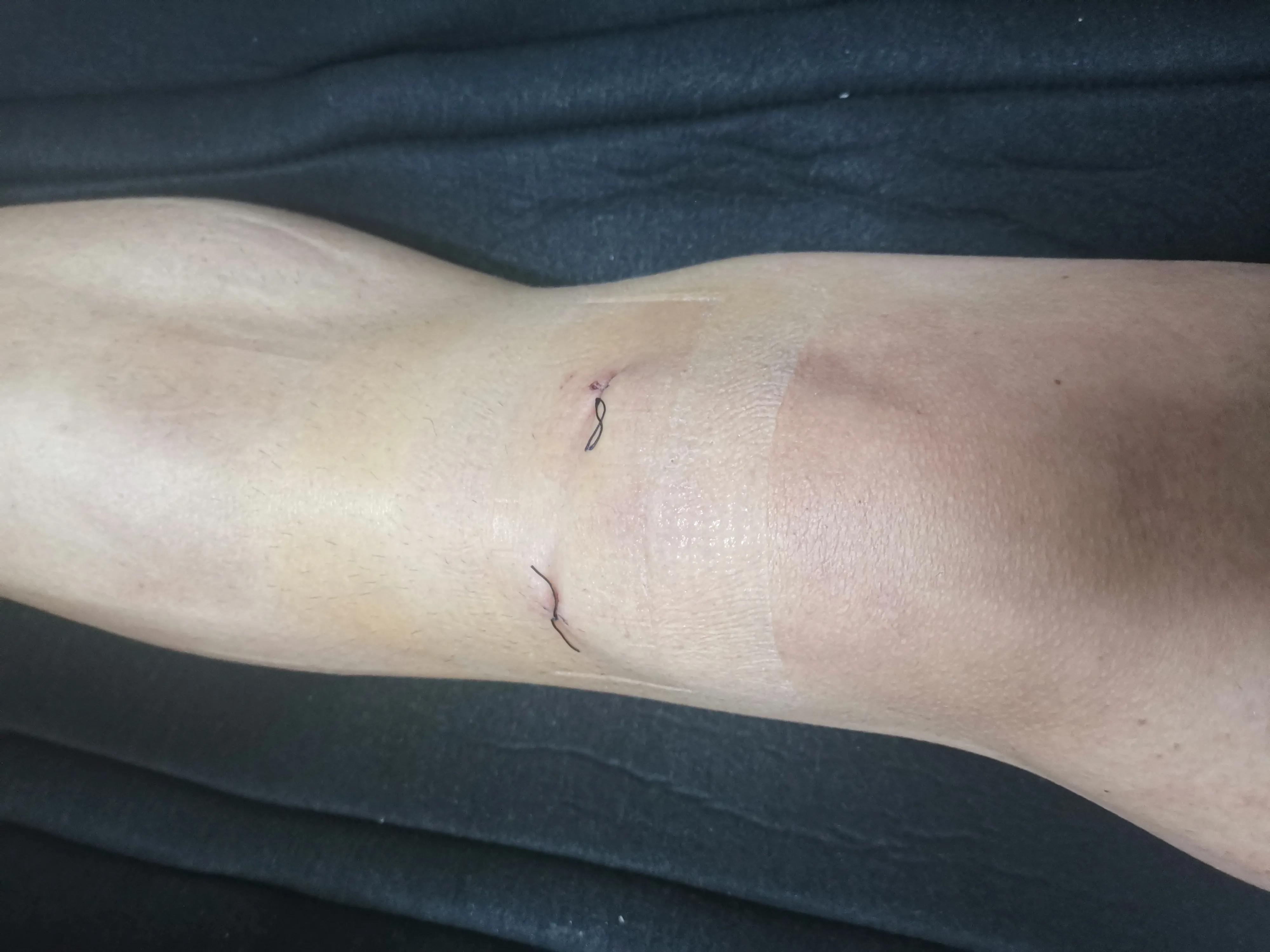 后角半月板撕裂微创手术,半月板撕裂微创手术沈阳