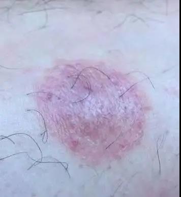 杏林微科普怎么养生,杏林微科普痔疮能自愈吗