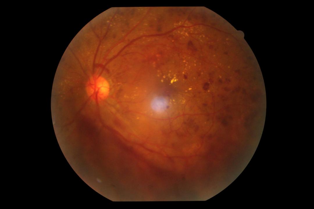 糖尿病并发症警惕“视力”杀手——中医中药如何治疗？