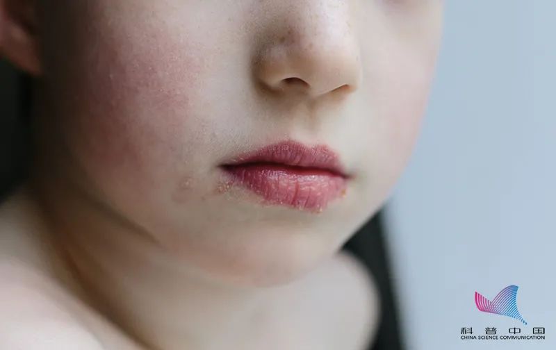 一直烂嘴角是什么病的前兆,烂嘴角会是癌症前兆吗