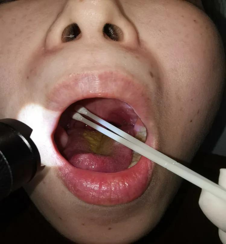 口咽、鼻咽拭子采集标准