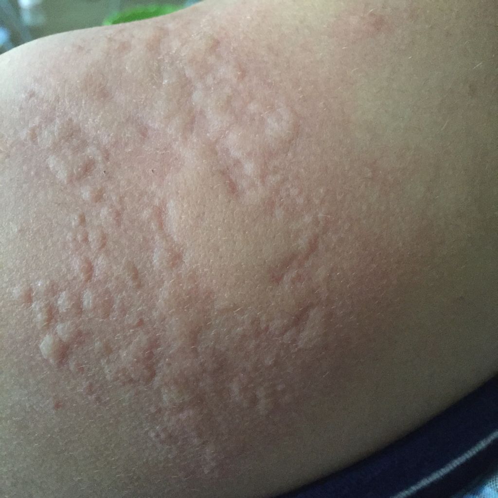 孩子荨麻疹痒得受不了怎么办,荨麻疹痒得不行了怎么办