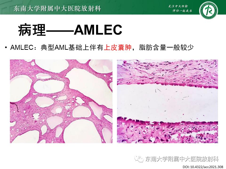 好文分享——《肾血管平滑肌脂肪瘤》