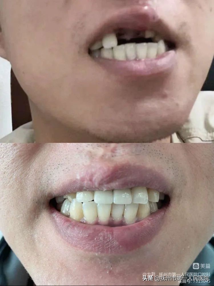 种植牙可修复多种牙齿缺失类型,学科建设口腔科