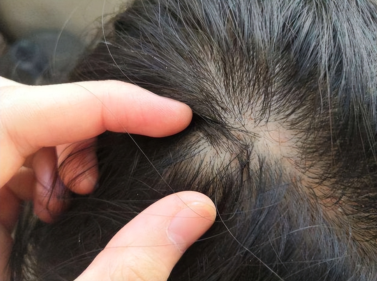 为啥头皮总长“脓包”和“疙瘩”？提示：或与这4点有关