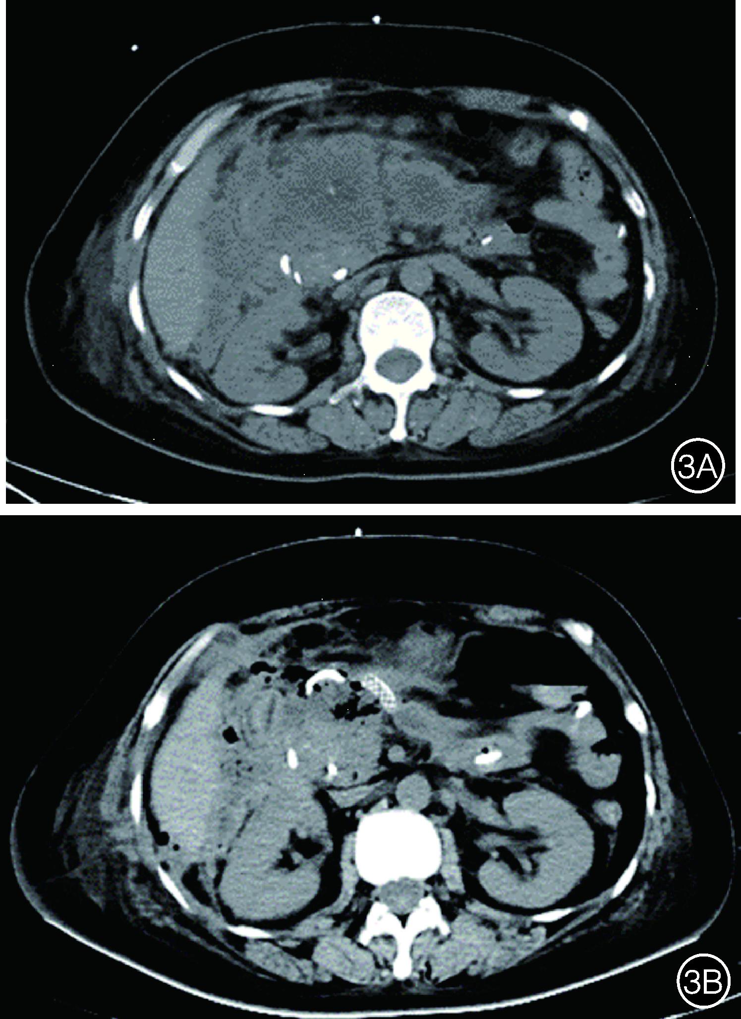 经皮肾镜治疗胰腺炎,内镜下胰腺坏死组织清创引流术