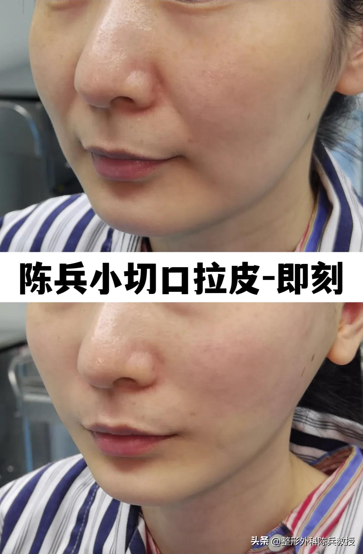 抗衰大拉皮,拉皮作为面部抗衰项目要注意哪些