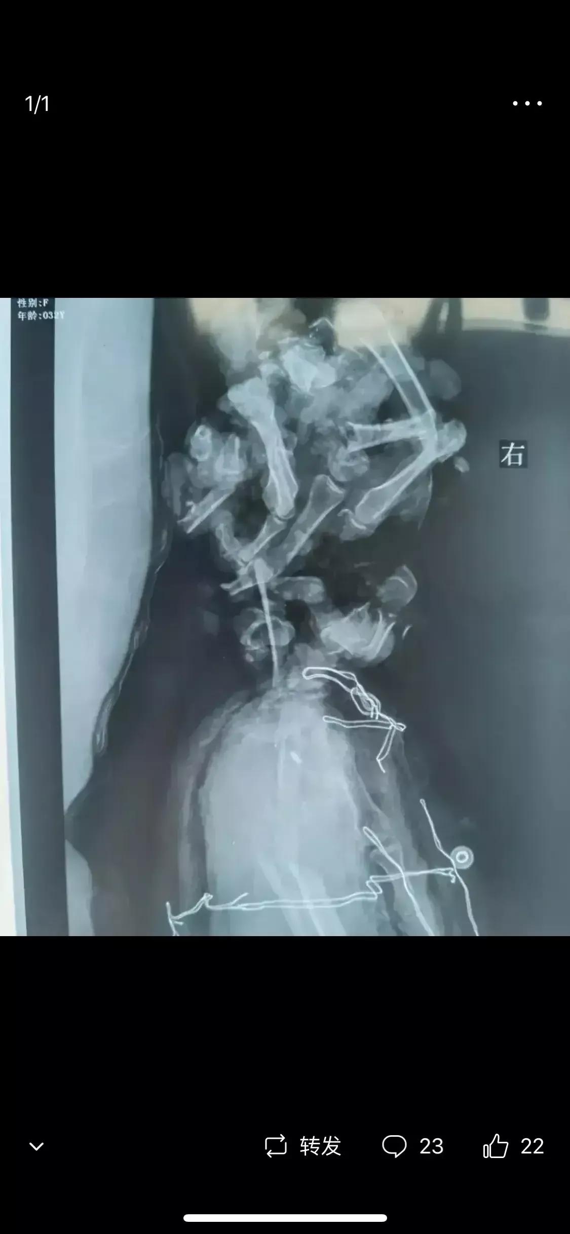 手被人砍了是民事还是刑事责任,手被砍到什么情况才算重伤