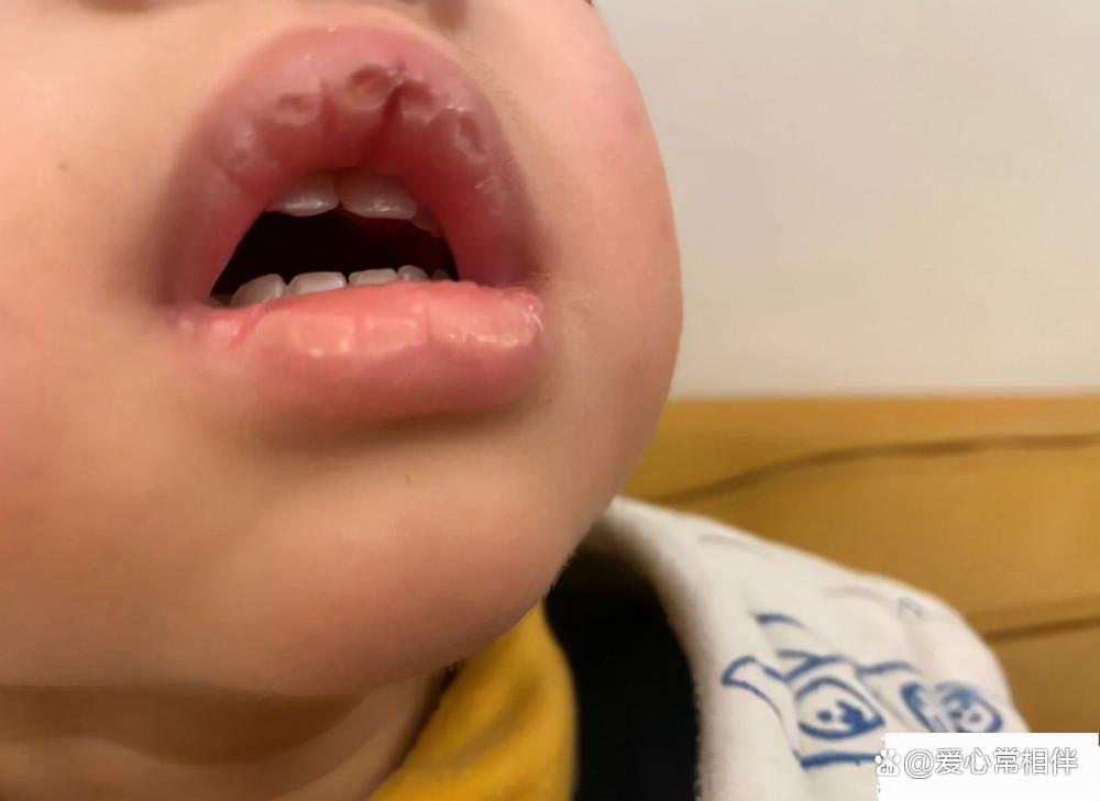 小孩嘴皮溃烂最快消除方法,孩子嘴干起皮怎么办