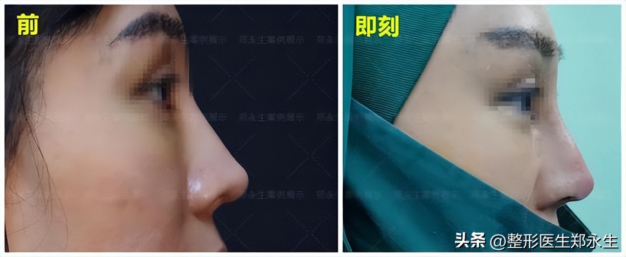 鼻子不满意在原医院修复要钱吗,鼻子坑修复最有效的方法