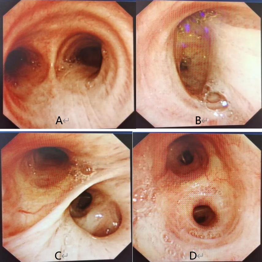 感染后稍微活动喘胸闷心悸,pjp感染
