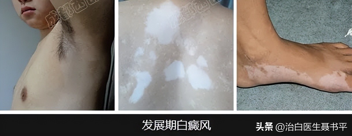 他克莫司软膏治疗白癜风怎么涂,他克莫司软膏用多久可以治白癜风