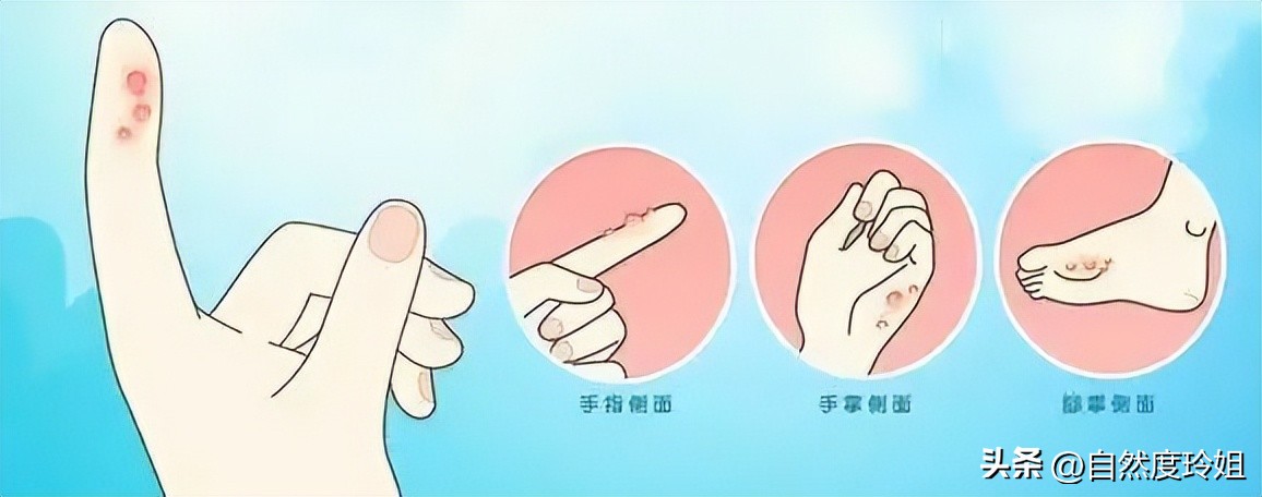 一到夏天手脚长水泡,冬天手脚反复长小水泡很痒怎么治