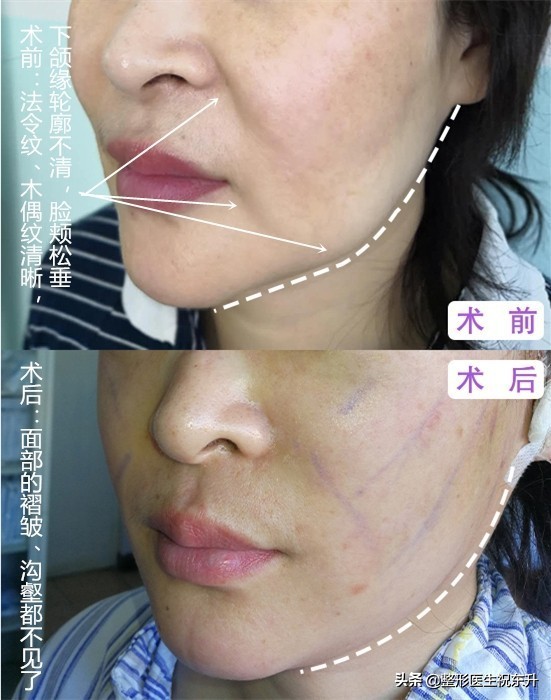 脸上有法令纹用什么办法把它消掉,法令纹和木偶纹的消除方法