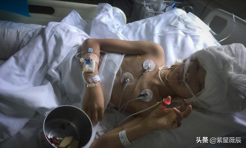 16岁女孩救弟弟严重烧伤,11岁少年救妹妹被火烧伤