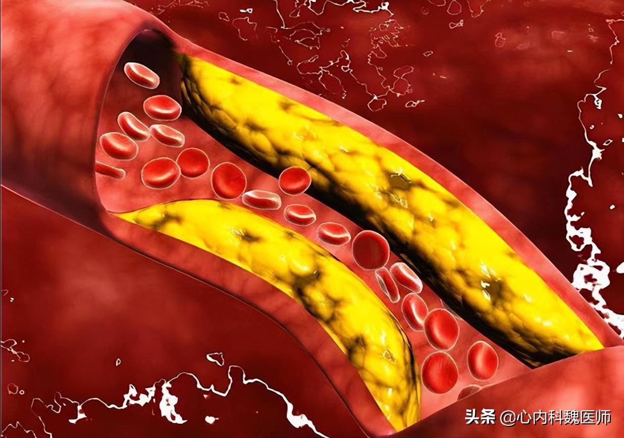 颈动脉斑块多大容易得脑梗,发现颈动脉血栓就离脑梗不远了
