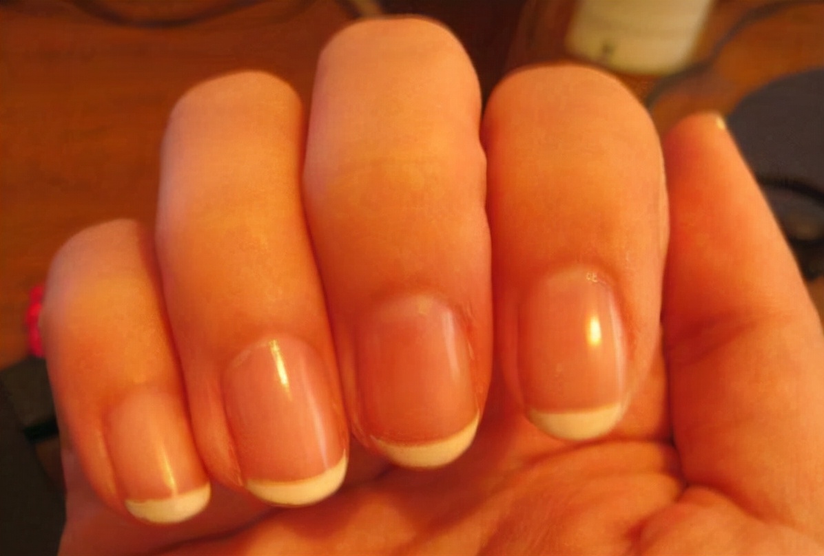 预防灰指甲用什么药效果好,跟灰指甲的人一起生活如何预防