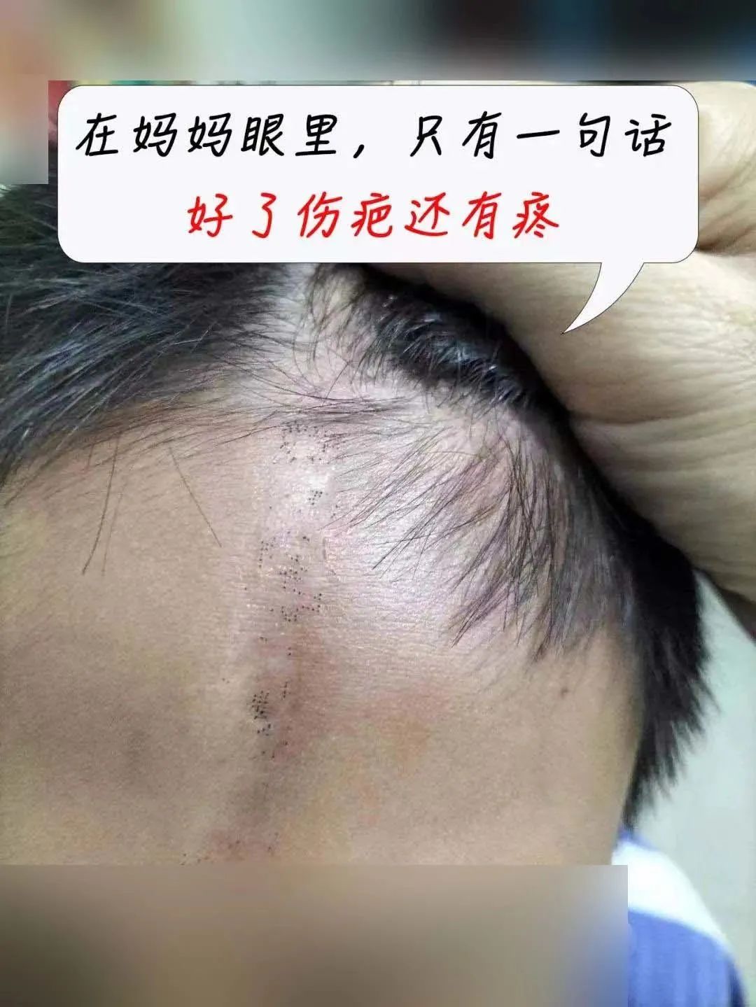 11岁男童额头上长满小疙瘩,10岁男孩子额头长斑