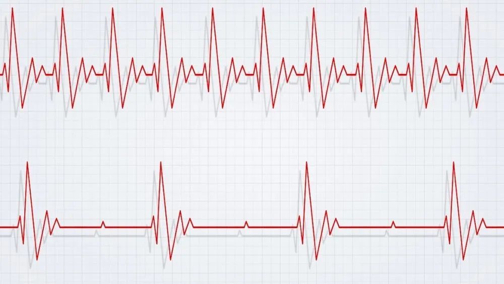 心率快是呼吸快还是慢,心率快好还是慢了好